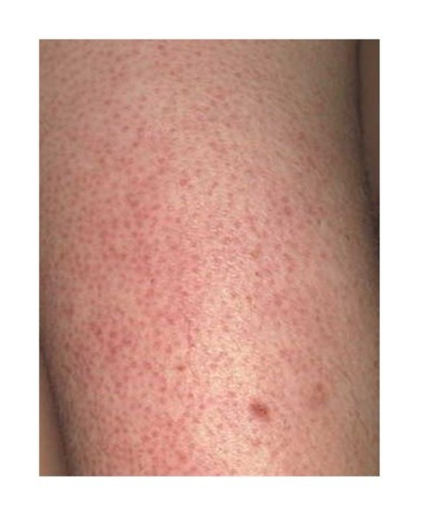 Everything You Should Know About The Bumpy Red Skin On Your Arms Called Keratosis Pilaris - picture 5