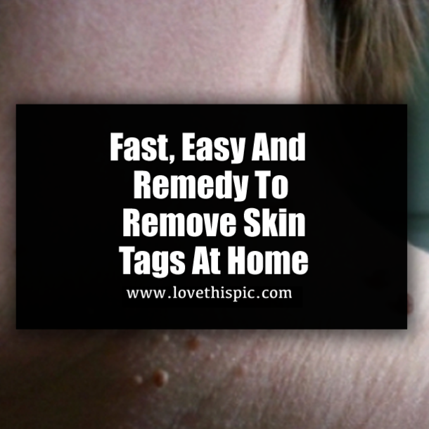 Fast, Easy And Remedy To Remove Skin Tags At Home
