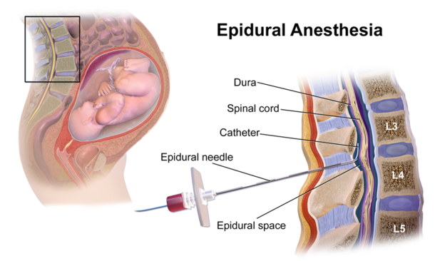 FDA Issues Serious Warning About The Terrifying Risks Of Epidural Steroid Injections For Back, Neck Pain - picture 2