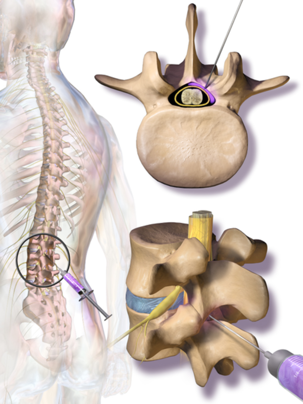 FDA Issues Serious Warning About The Terrifying Risks Of Epidural Steroid Injections For Back, Neck Pain - picture 3