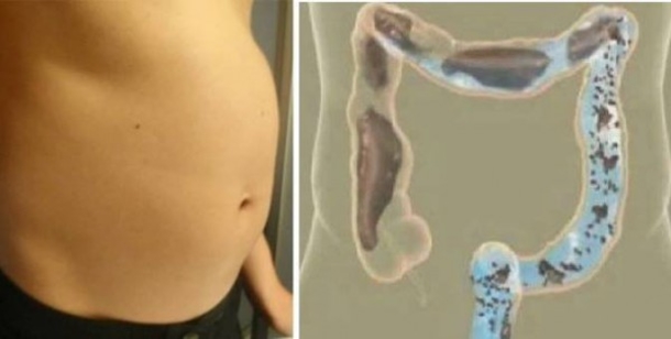 Feeling Bloated? This is Why and What You Should Do To Help Relieve Constipation and Bloating - picture 2