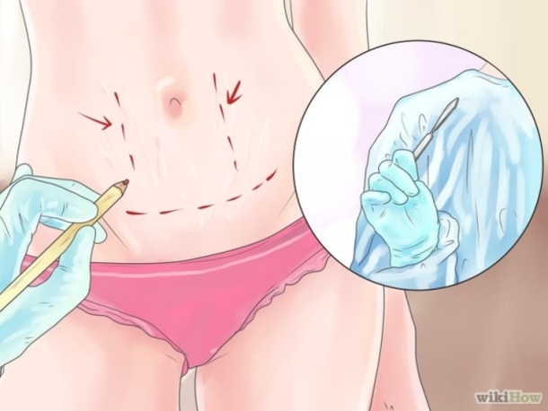 Get Rid Of Stretch Marks RIGHT NOW Using These Methods, They Work! - picture 6