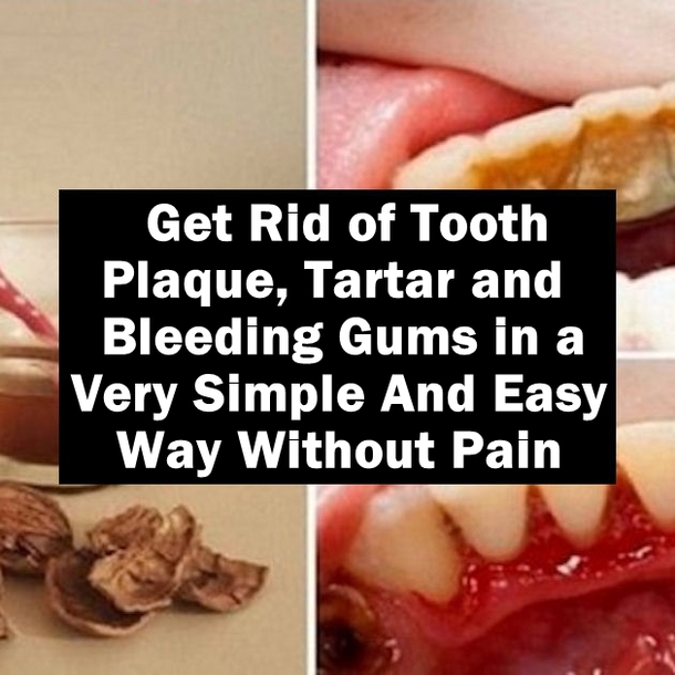 Get Rid of Tooth Plaque, Tartar and Bleeding Gums in a Very Simple And Easy Way Without Pain...