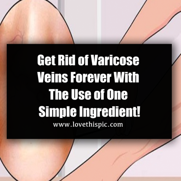 Get Rid of Varicose Veins Forever With The Use of One Simple Ingredient!