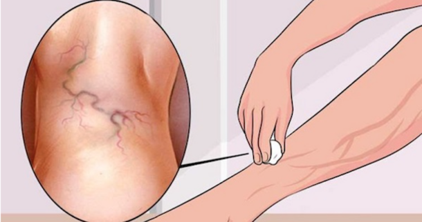 Get Rid of Varicose Veins Forever With The Use of One Simple Ingredient! - picture 2
