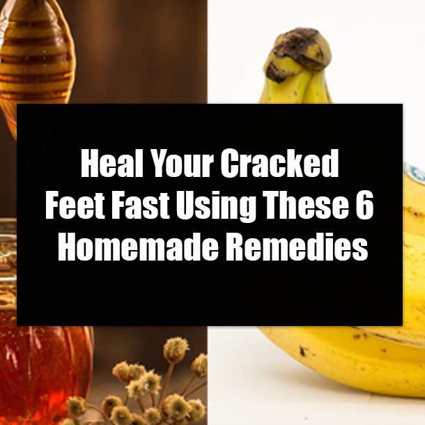 Heal Your Cracked Feet Fast Using These 6 Homemade Remedies