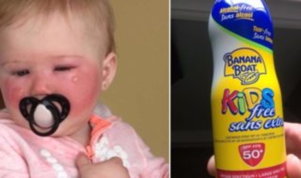 Her Daughter’s Face Turned Red And Blistered, Now This Grieving Mom Is Warning Every Parent - picture 3