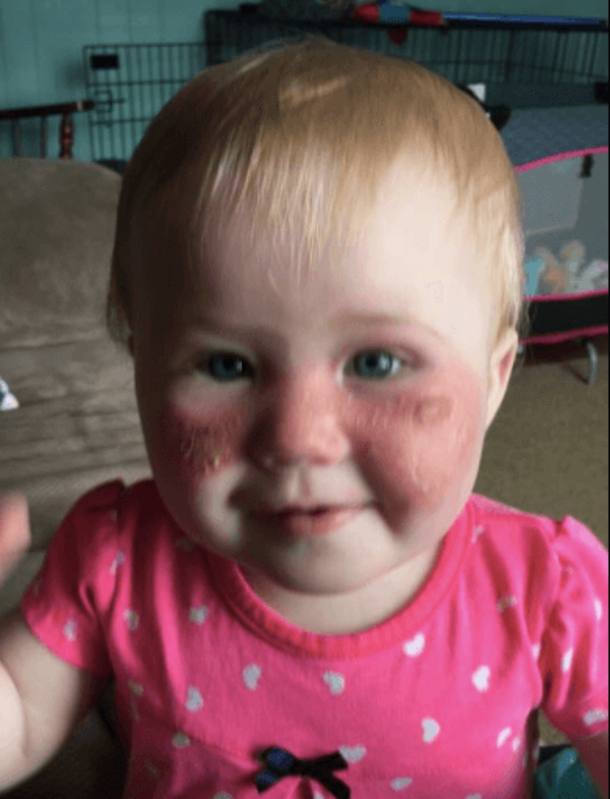 Her Daughter’s Face Turned Red And Blistered, Now This Grieving Mom Is Warning Every Parent - picture 4