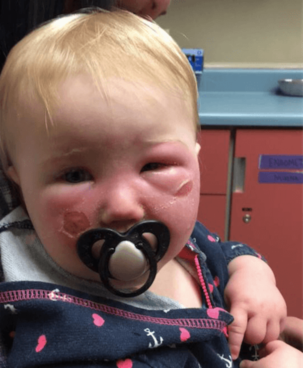 Her Daughter’s Face Turned Red And Blistered, Now This Grieving Mom Is Warning Every Parent - picture 5