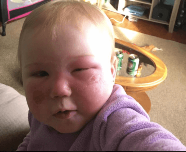 Her Daughter’s Face Turned Red And Blistered, Now This Grieving Mom Is Warning Every Parent - picture 6