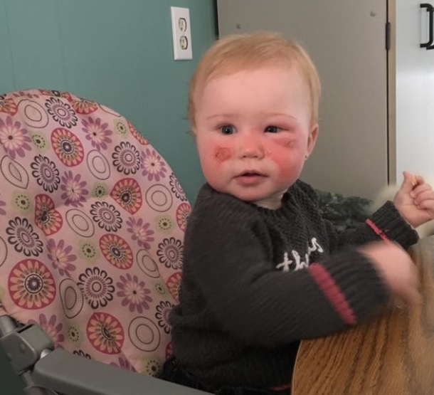 Her Daughter’s Face Turned Red And Blistered, Now This Grieving Mom Is Warning Every Parent - picture 7