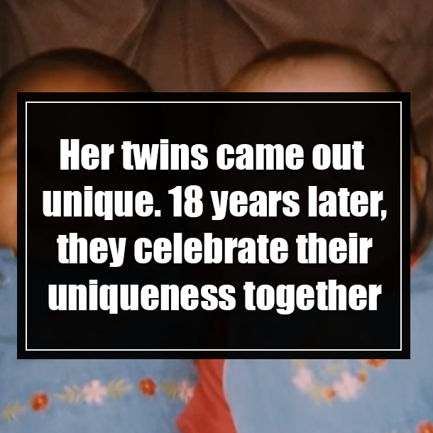 Her twins came out unique. 18 years later, they celebrate their uniqueness together