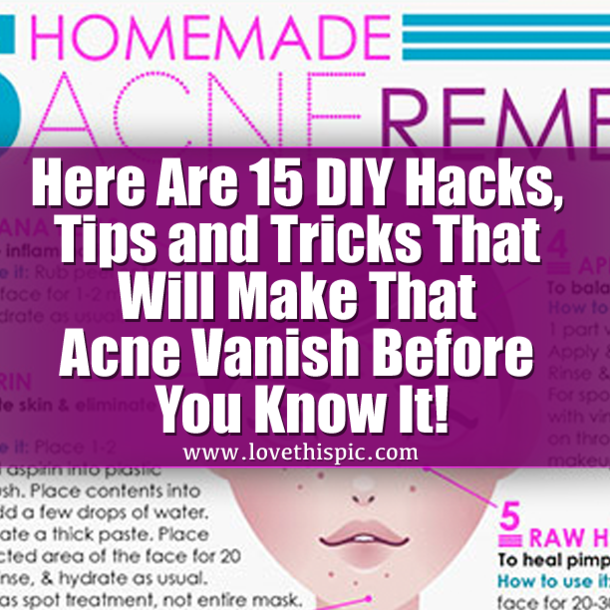 Here Are 15 DIY Hacks, Tips and Tricks That Will Make That Acne Vanish Overnight!