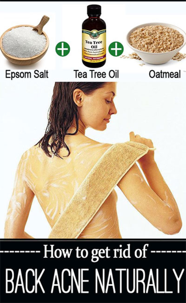 Here Are 15 DIY Hacks, Tips and Tricks That Will Make That Acne Vanish Overnight! - picture 11