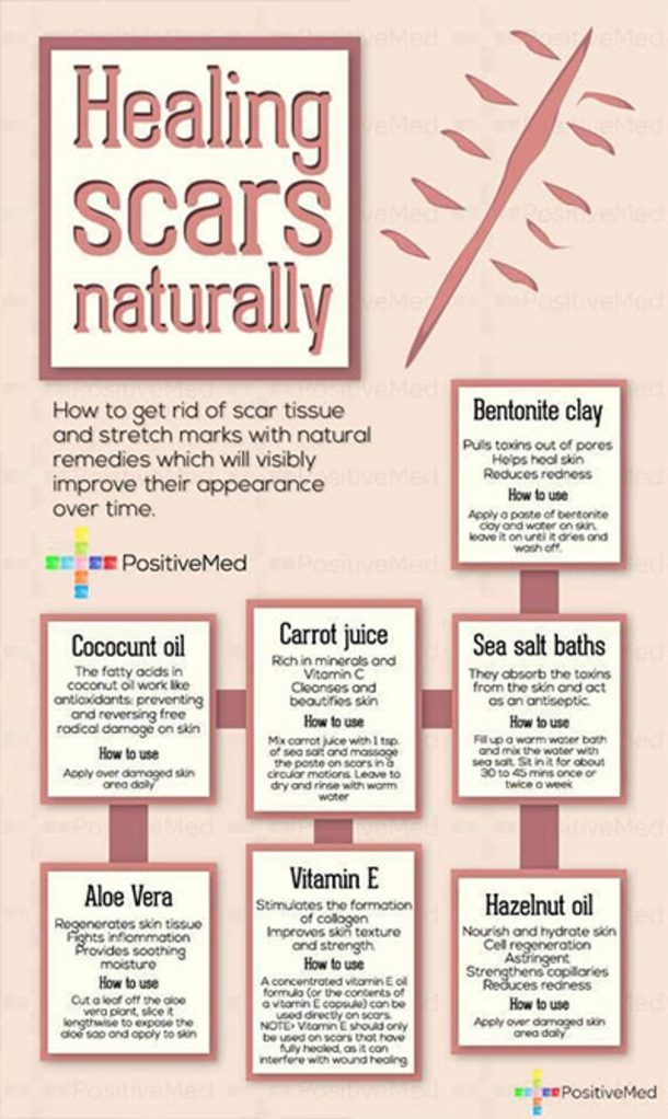 Here Are 15 DIY Hacks, Tips and Tricks That Will Make That Acne Vanish Overnight! - picture 16