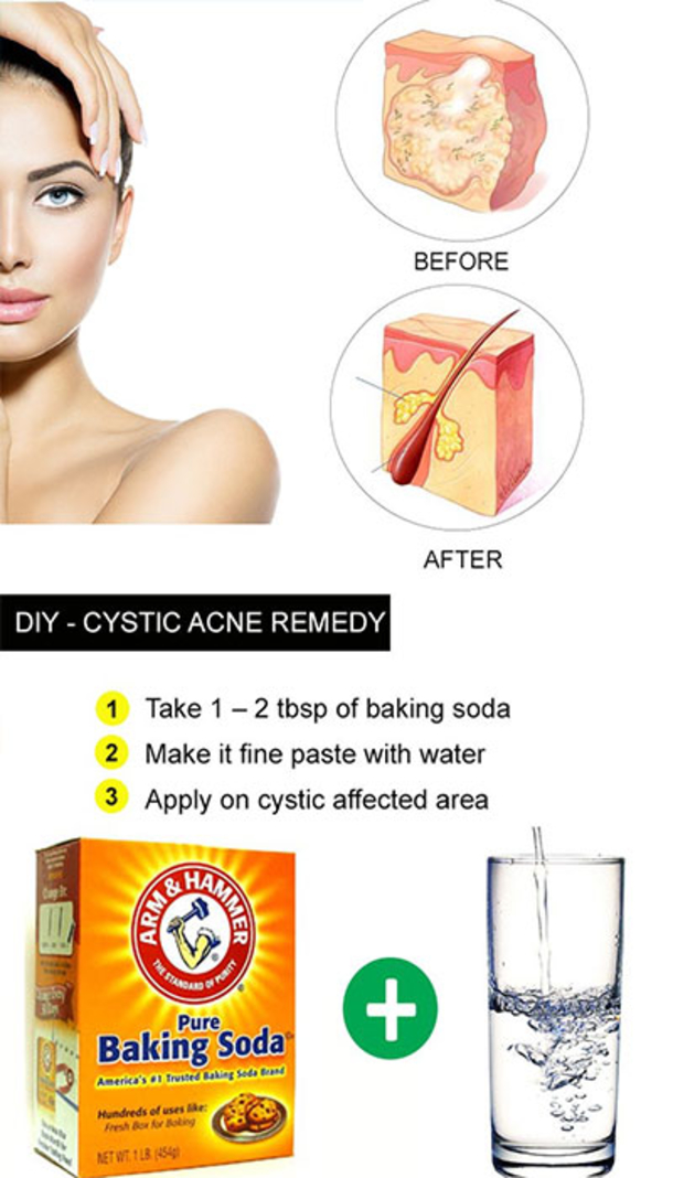 Here Are 15 DIY Hacks, Tips and Tricks That Will Make That Acne Vanish Overnight! - picture 3
