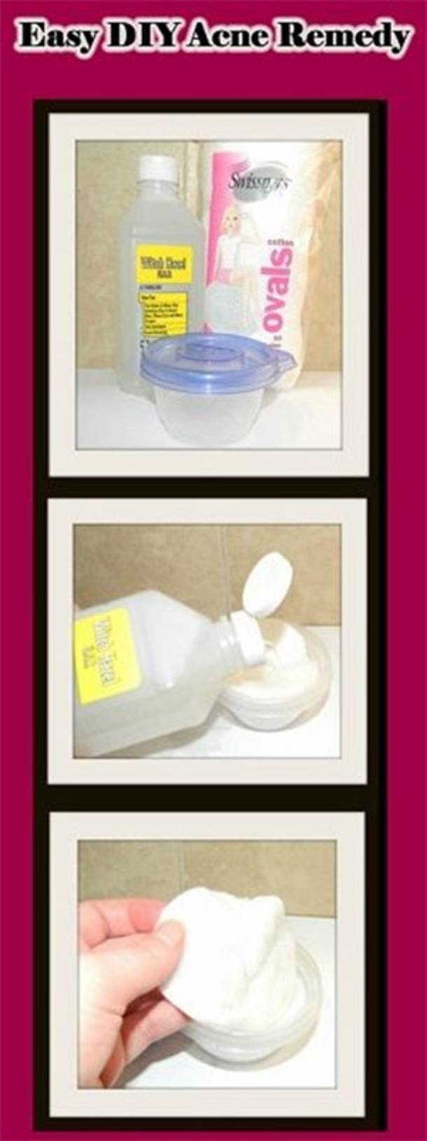 Here Are 15 DIY Hacks, Tips and Tricks That Will Make That Acne Vanish Overnight! - picture 6