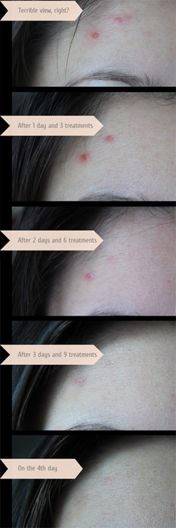 Here Are 15 DIY Hacks, Tips and Tricks That Will Make That Acne Vanish Overnight! - picture 7