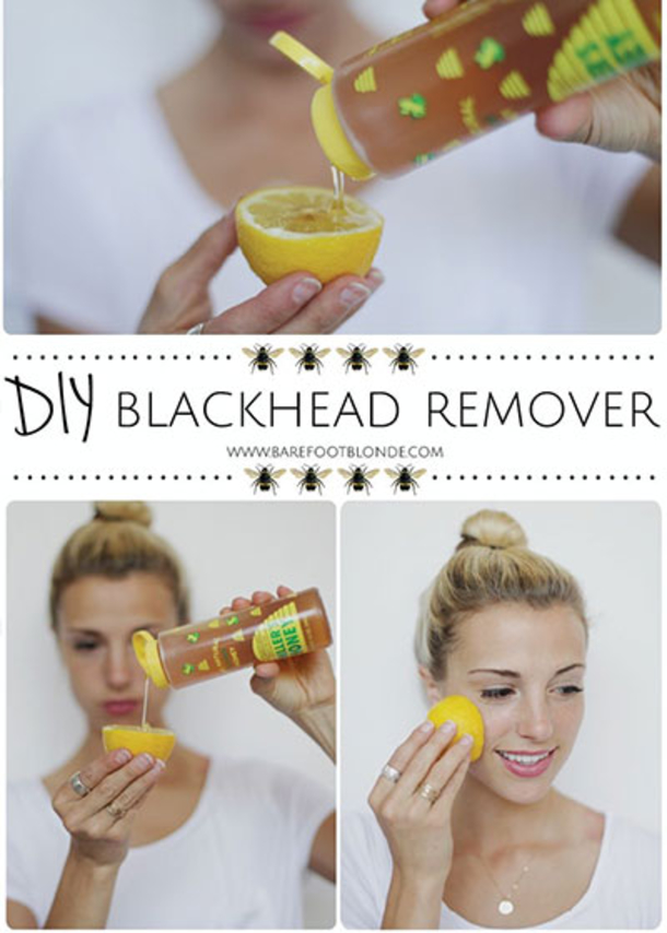 Here Are 15 DIY Hacks, Tips and Tricks That Will Make That Acne Vanish Overnight! - picture 9