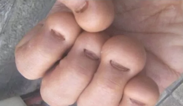 Here Are 9 Reasons Why You Should NOT Bite Your Nails... - picture 2