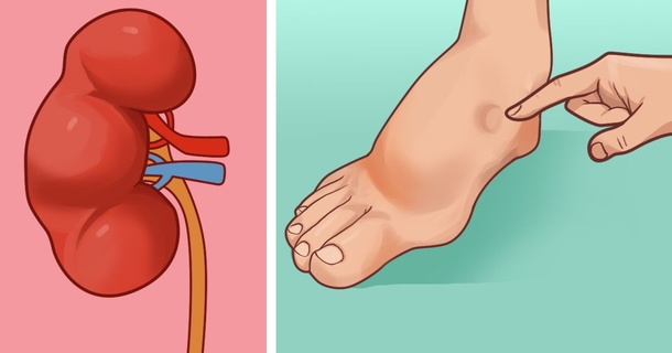 Here Are Some Signs Of Kidney Disease You Should Know About. Don’t Ignore The Symptoms - picture 2