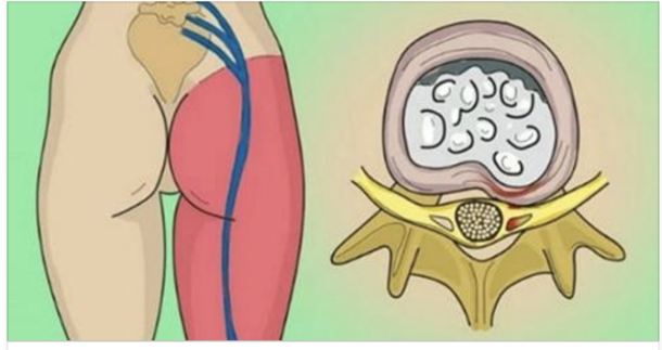 Here Are Two Exercises That Help ​A Pinched Nerve in the Lumbar Area & Cure Sciatic Pain - picture 2