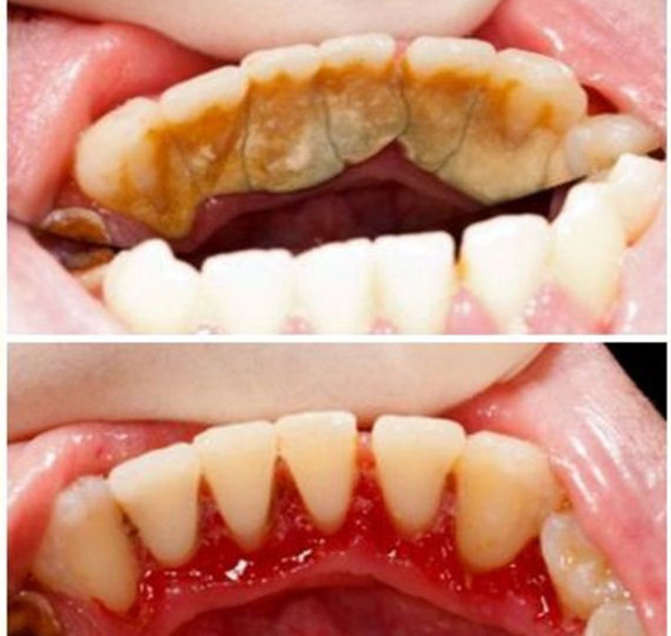 Here Is How To Get Rid Of Tartar With Only One Simple Ingredient - picture 2