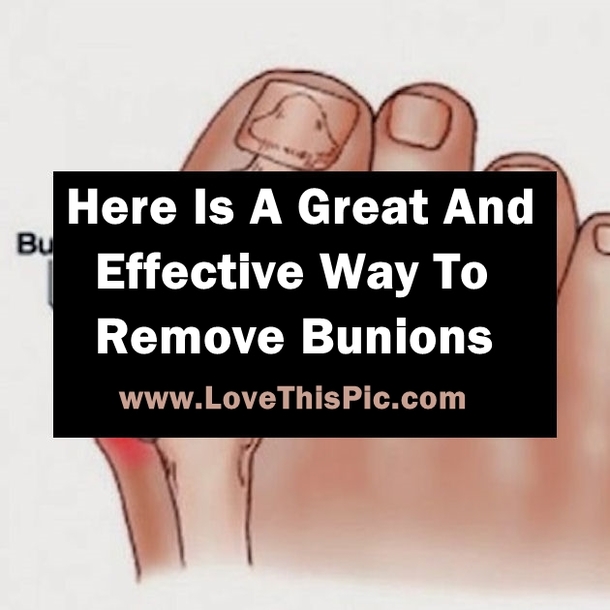 Here Is The Best And Most Effective Way To Easily Remove Bunions...