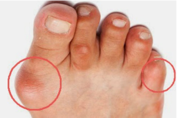 Here Is The Best And Most Effective Way To Easily Remove Bunions... - picture 2