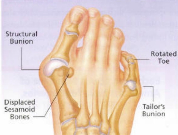 Here Is The Best And Most Effective Way To Easily Remove Bunions... - picture 3
