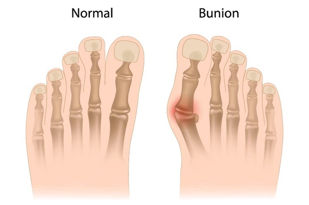 Here Is The Best And Most Effective Way To Easily Remove Bunions... - picture 5