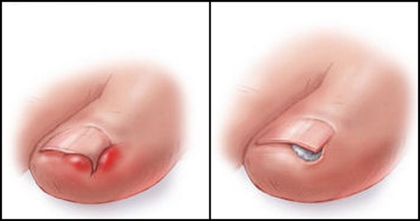 Here Is What You Should Know About Ingrown Toenails And How To Treat Them - picture 2