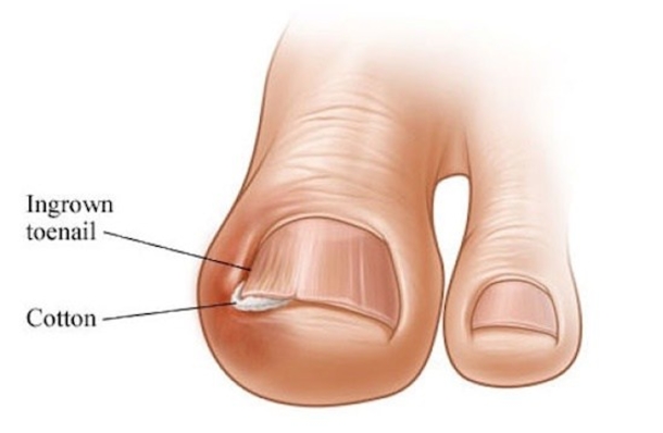 Here Is What You Should Know About Ingrown Toenails And How To Treat Them - picture 3