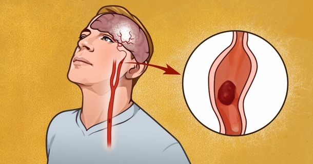 Here's 7 early warning signs of stroke everyone should know - picture 2