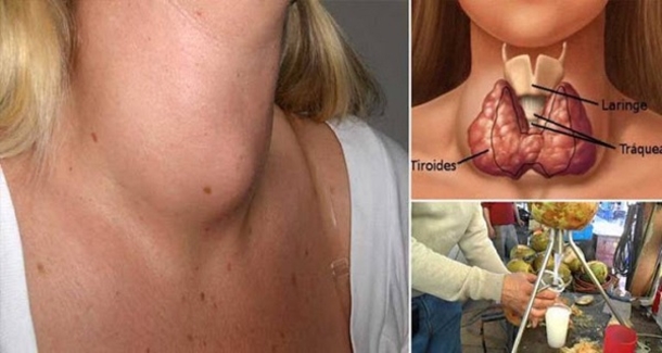 Here’s How To Cure Your Thyroid Gland With Just One Ingredient! - picture 2