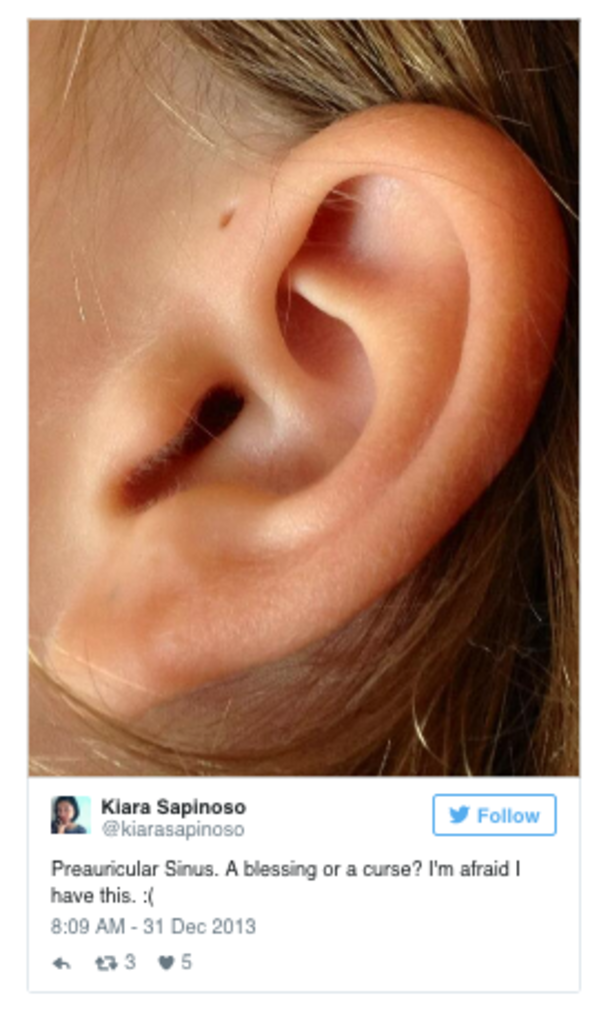 Here’s Why Some People Have an Extra Hole in Their Ears! - picture 4