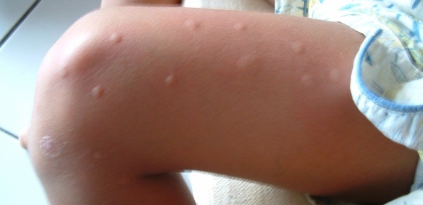 Here’s Why You’re a Mosquito Magnet - picture 2