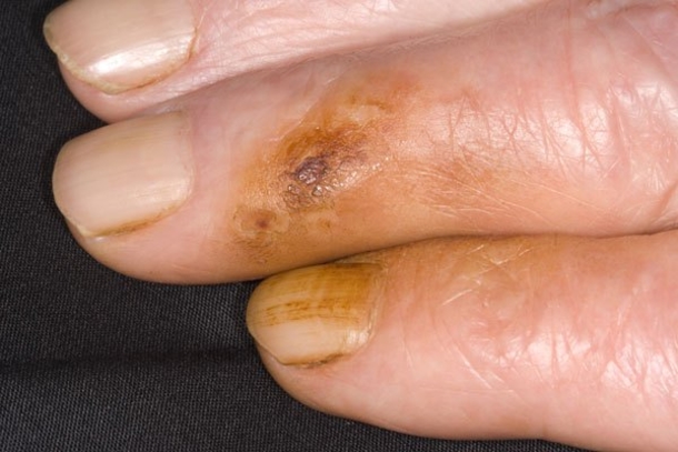 How Cigarette Smoking Affects Your Whole Body - picture 7