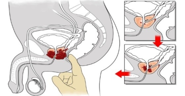 How Ginger Destroys Prostate, Ovarian and Colon Cancer Better Than Chemo - picture 2