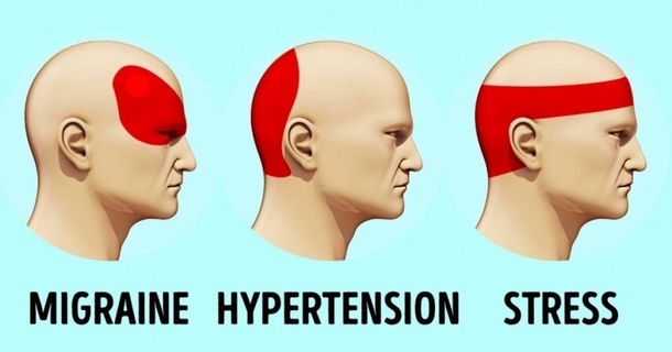 How to Get Rid of a Headache in 5 Minutes Without Pills - picture 2