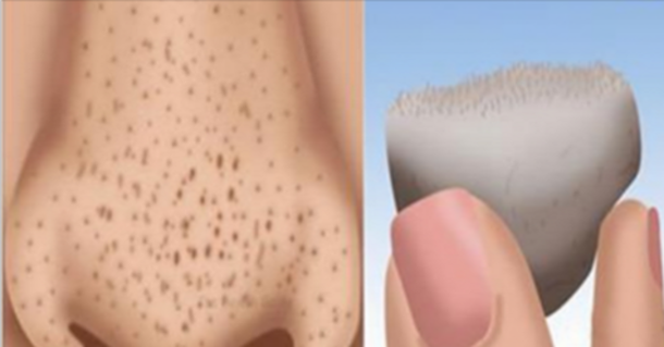 How To Get Rid Of Blackheads Quickly At Home! Fast And Easy Natural Remedies! - picture 2