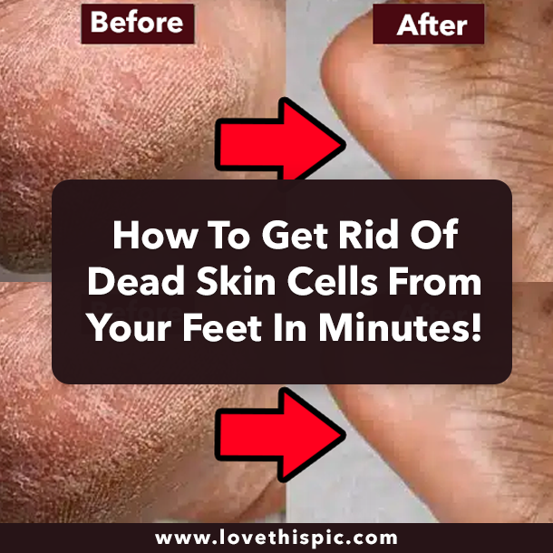How To Get Rid Of Dead Skin Cells From Your Feet In Minutes!