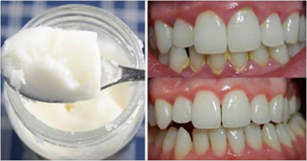 How To Make Homemade Toothpaste And Remove Mouth Odor, Tartar, Plaque & Brighten Your Teeth - picture 2