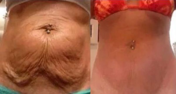 How To Make Your Saggy Stomach Skin Smooth Naturally With This Natural Remedy - picture 2