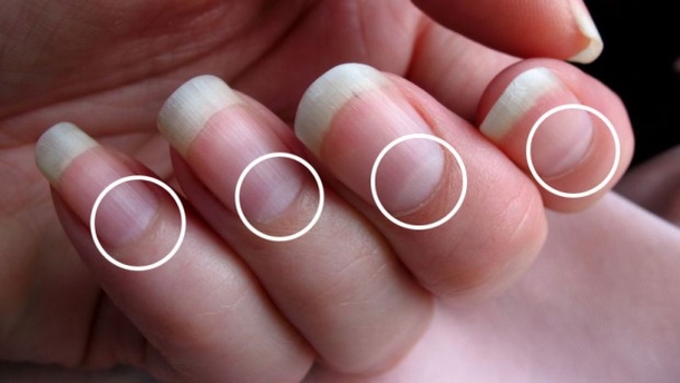If You Do Not Have Half Moon Shape On Your Nails, Immediately Visit a Doctor! - picture 2