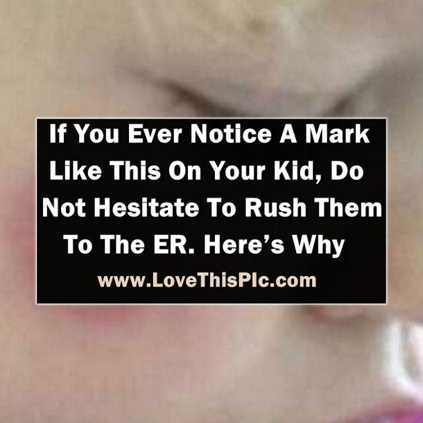If You Ever Notice A Mark Like This On Your Kid, Do Not Hesitate To Rush Them To The ER. Here’s Why