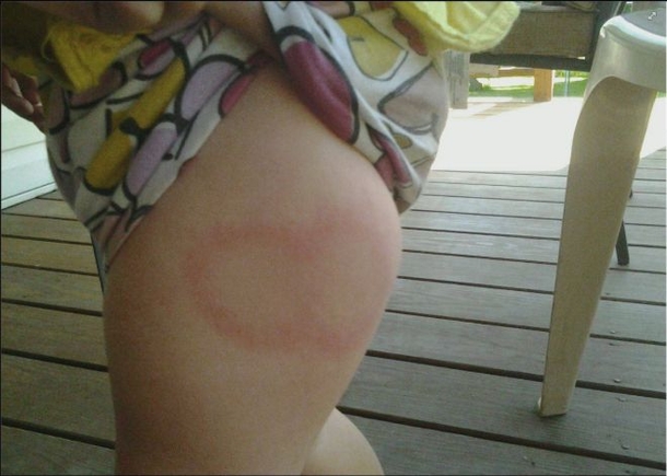 If You Ever Notice A Mark Like This On Your Kid, Do Not Hesitate To Rush Them To The ER. Here’s Why - picture 2