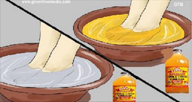 If You Soak Your Feet In Apple Cider Vinegar, THIS Is What Happens… That’s Amazing! - picture 2
