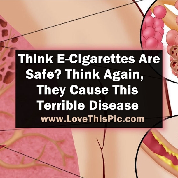 If You Think E-Cigarettes Are Safe Then Think Again. They Cause This Terrible Disease...