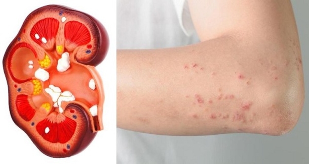 If Your Kidney Is In Danger, The Body Will Give You These 8 Signs! - picture 2
